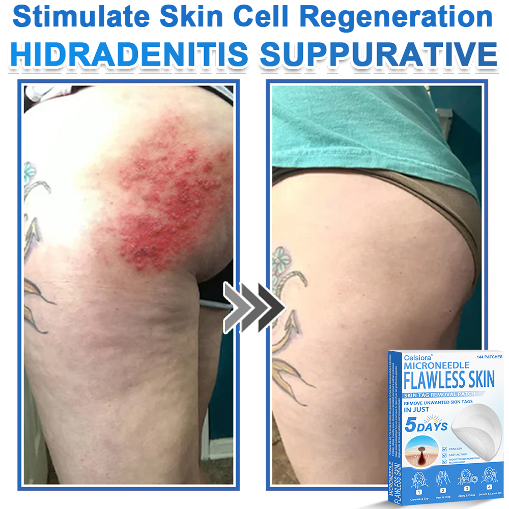 👩‍⚕️Celsiora® 2-in-1 Microneedle & Hydrocolloid Patch | Raised Moles,Acne,  Flat Warts & Skin Tags Remover | Improves Wrinkles, Blemishes & Scars | Invisible Pimple Patches for Face & Body