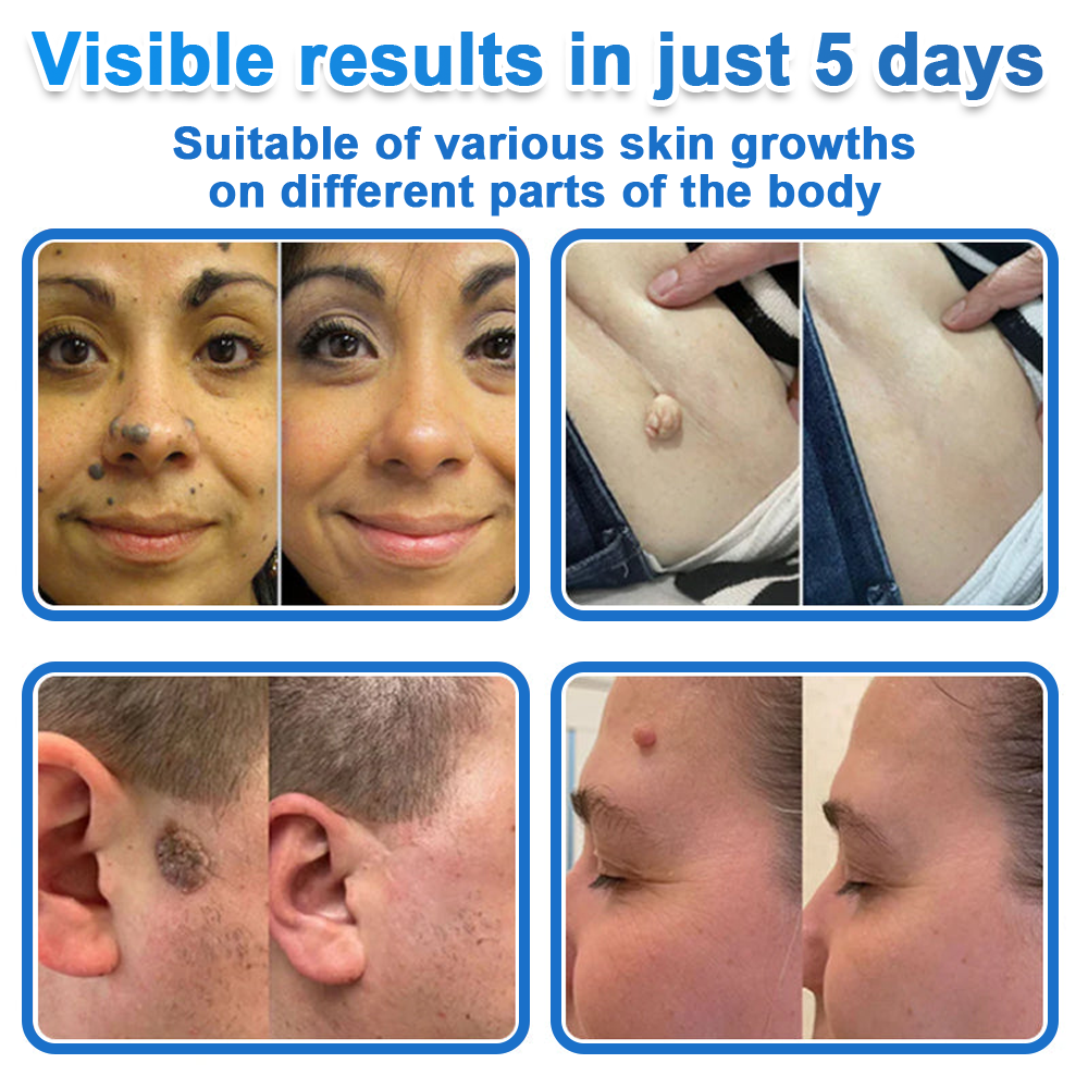 👩‍⚕️Celsiora® 2-in-1 Microneedle & Hydrocolloid Patch | Raised Moles,Acne,  Flat Warts & Skin Tags Remover | Improves Wrinkles, Blemishes & Scars | Invisible Pimple Patches for Face & Body