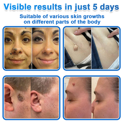 👩‍⚕️Celsiora® 2-in-1 Microneedle & Hydrocolloid Patch | Raised Moles,Acne,  Flat Warts & Skin Tags Remover | Improves Wrinkles, Blemishes & Scars | Invisible Pimple Patches for Face & Body