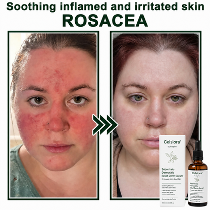 Celsiora® Seborrheic Dermatitis Relief Derm Serum