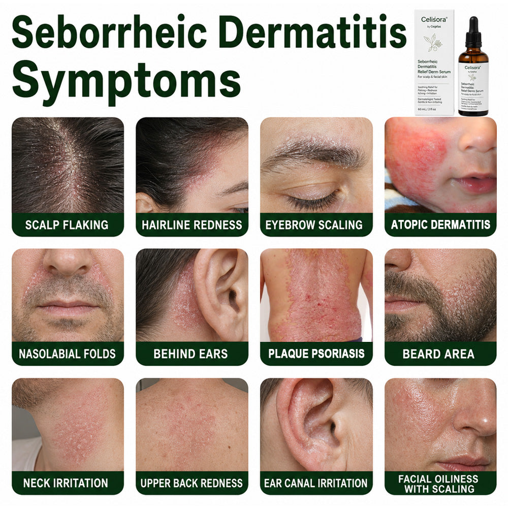 💚Celsiora® Seborrheic Dermatitis Relief Derm Serum