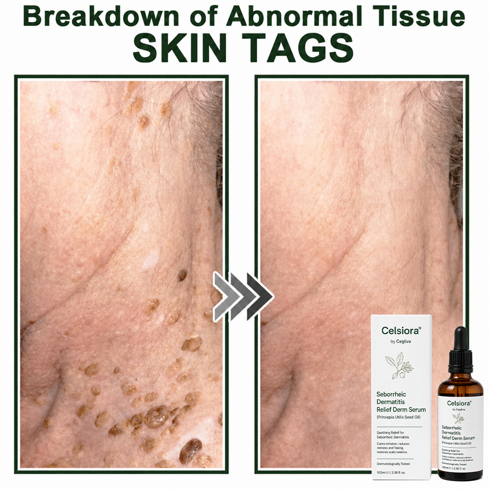 Celsiora® Seborrheic Dermatitis Relief Derm Serum
