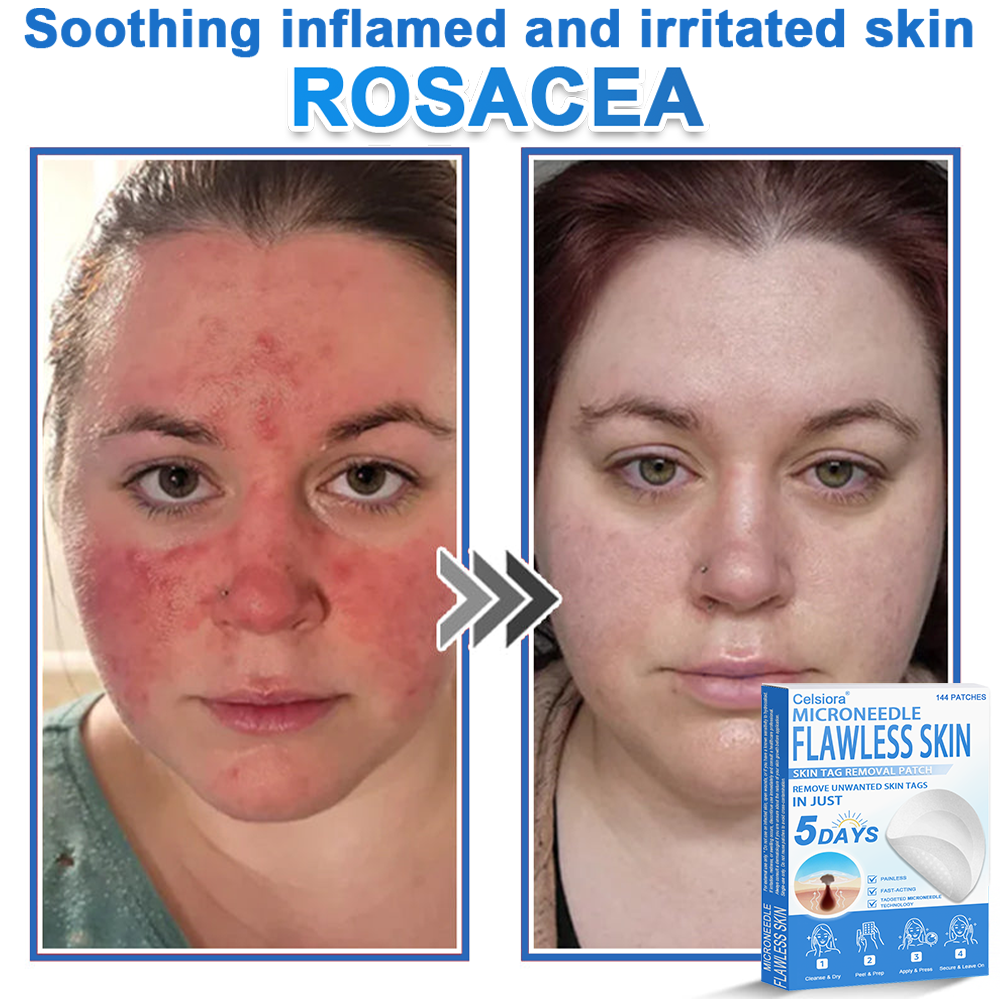 👩‍⚕️Celsiora® 2-in-1 Microneedle & Hydrocolloid Patch | Raised Moles,Acne,  Flat Warts & Skin Tags Remover | Improves Wrinkles, Blemishes & Scars | Invisible Pimple Patches for Face & Body