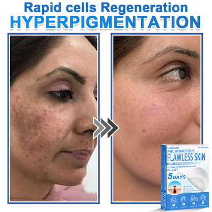 👩‍⚕️Celsiora® 2-in-1 Microneedle & Hydrocolloid Patch | Raised Moles,Acne,  Flat Warts & Skin Tags Remover | Improves Wrinkles, Blemishes & Scars | Invisible Pimple Patches for Face & Body