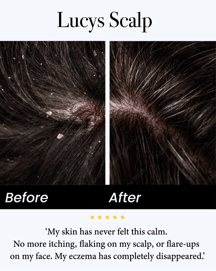 💚Celsiora® Seborrheic Dermatitis Relief Derm Serum