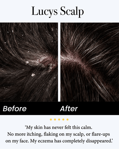 💚Celsiora® Seborrheic Dermatitis Relief Derm Serum